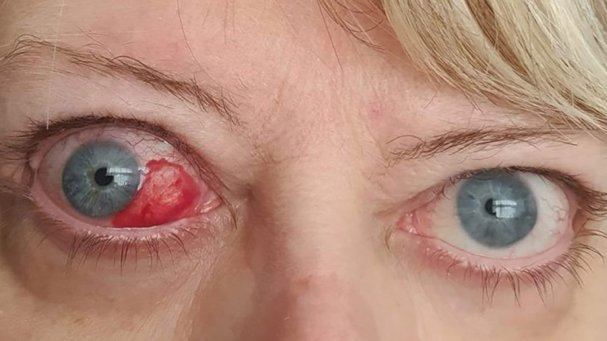 طبقه‌بندی بیماری تیروئید چشمی