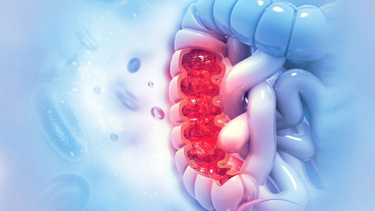 آزمایش بیومارکر سرطان روده بزرگ