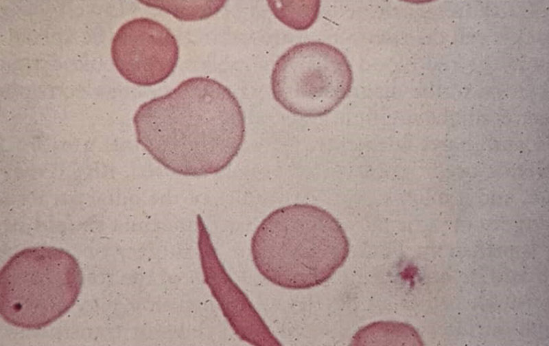 گسترش خون محیطی بیمار