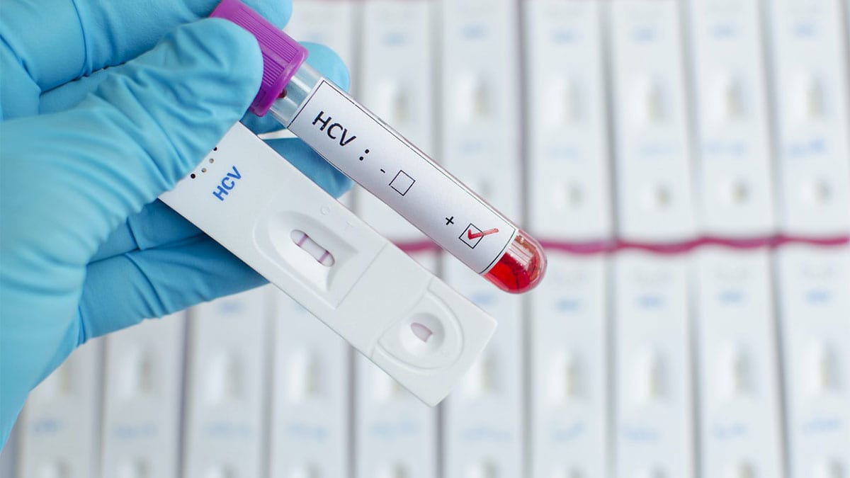 آزمایش تک‌ویزیتی HCV