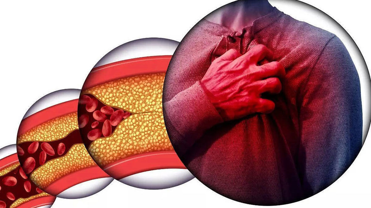 چاقی پنهان و آسیب شریان‌های کاروتید