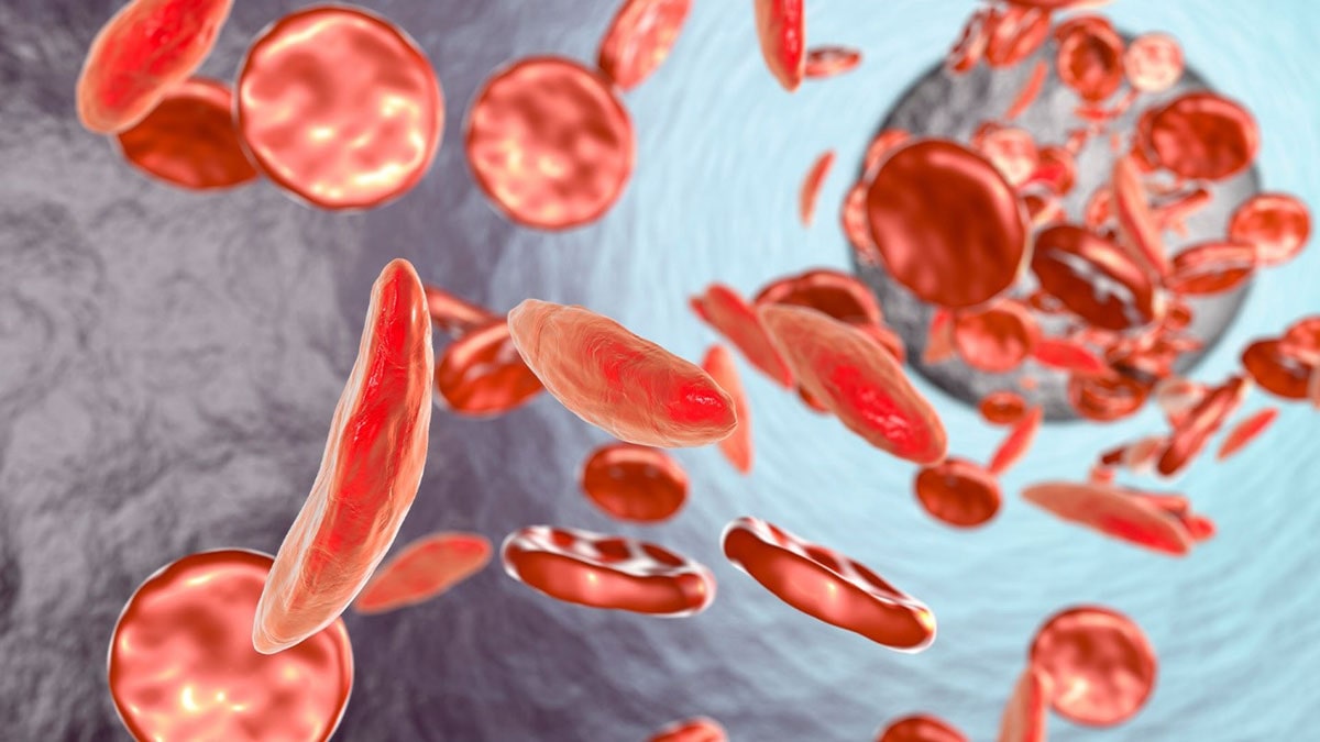 مدیریت بارداری زنان با سلول داسی شکل