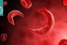 ارتباط بیماری سلول داسی شکل و بیومارکر پره‌اکلامپسی