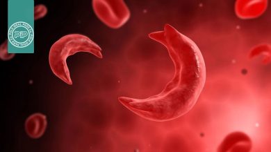 ارتباط بیماری سلول داسی شکل و بیومارکر پره‌اکلامپسی