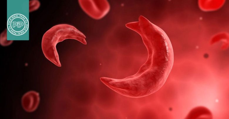ارتباط بیماری سلول داسی شکل و بیومارکر پره‌اکلامپسی