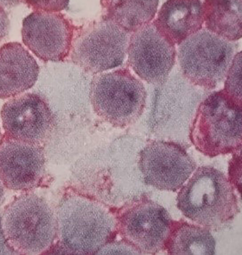 برای مارکرهای سلول‌های B مانند CD19 منفی هستند