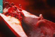 ارتباط چاقی احشایی و آسیب خاموش رگ‌ها