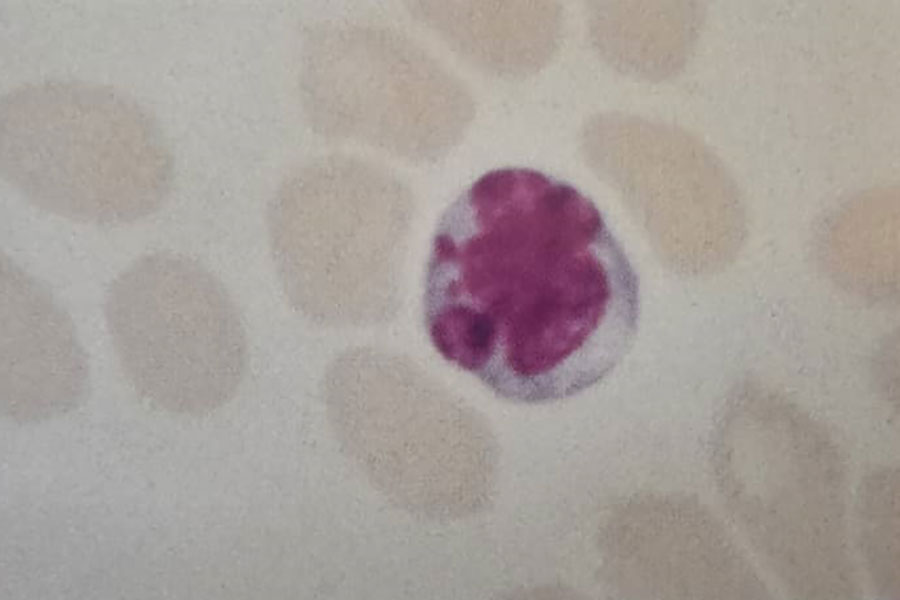 گسترش خون محیطی بیمار