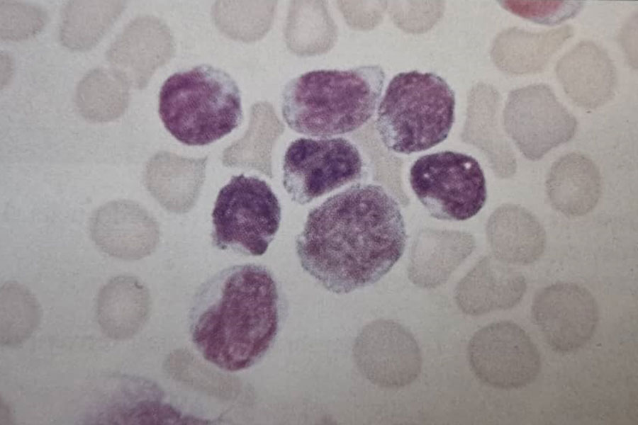 گسترش خون محیطی بیمار