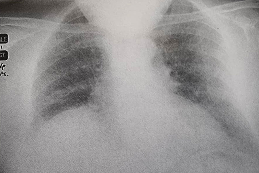 رادیوگرافی قفسه سینه