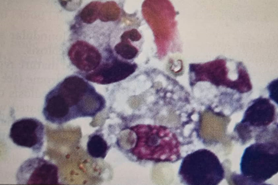 آسپیراسیون مغز استخوان بیمار