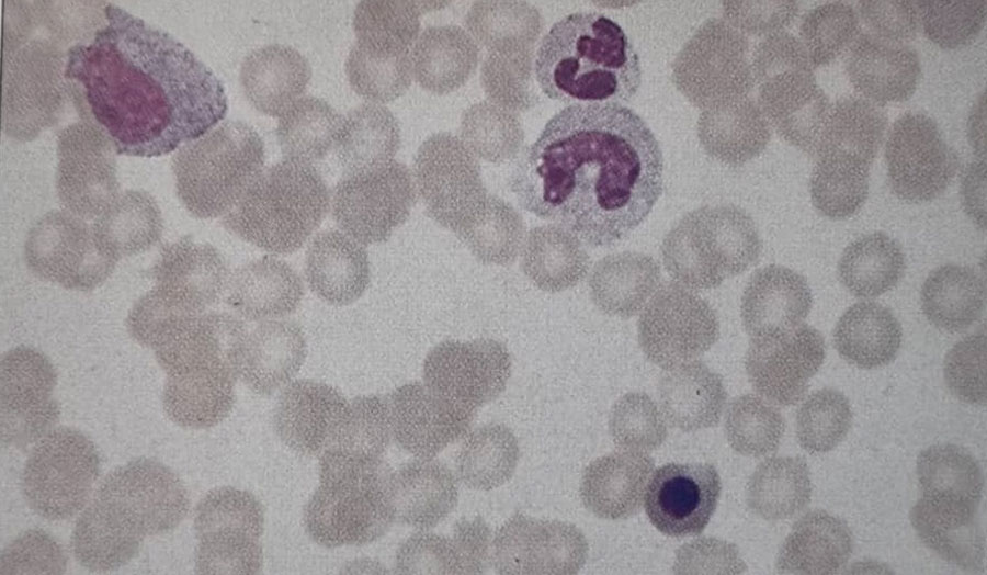 گسترش خون محیطی بیمار