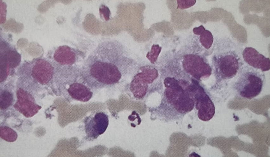 آسپیراسیون مغز استخوان