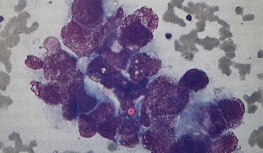 بیوپسی ترفین