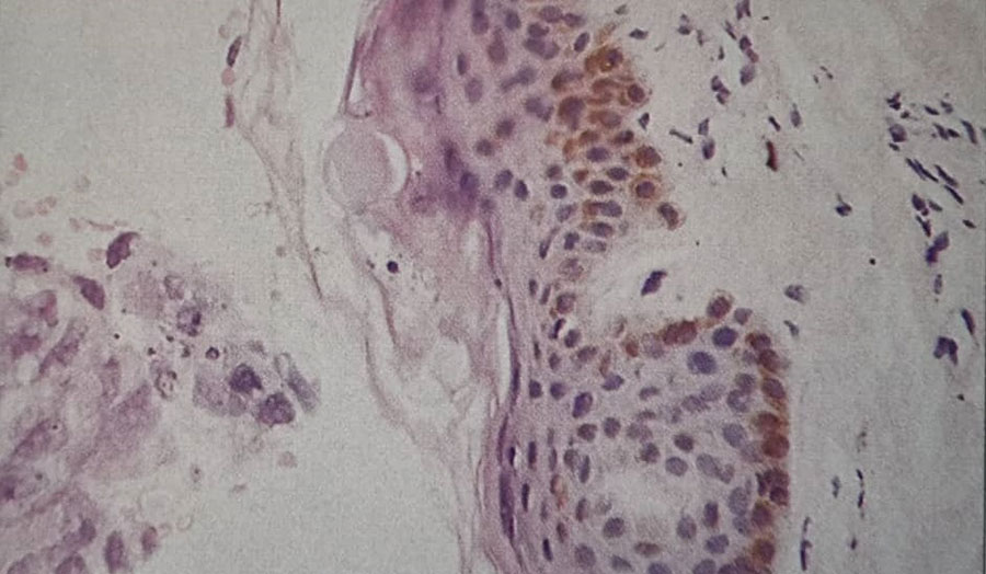 سلول‌هایی از کارسینوم معده در یک آسپیراسیون مغز استخوان