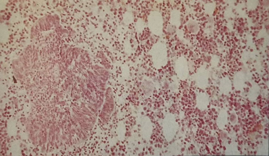 کارسینوم سلول اوت (Oat cell carcinoma) برونش