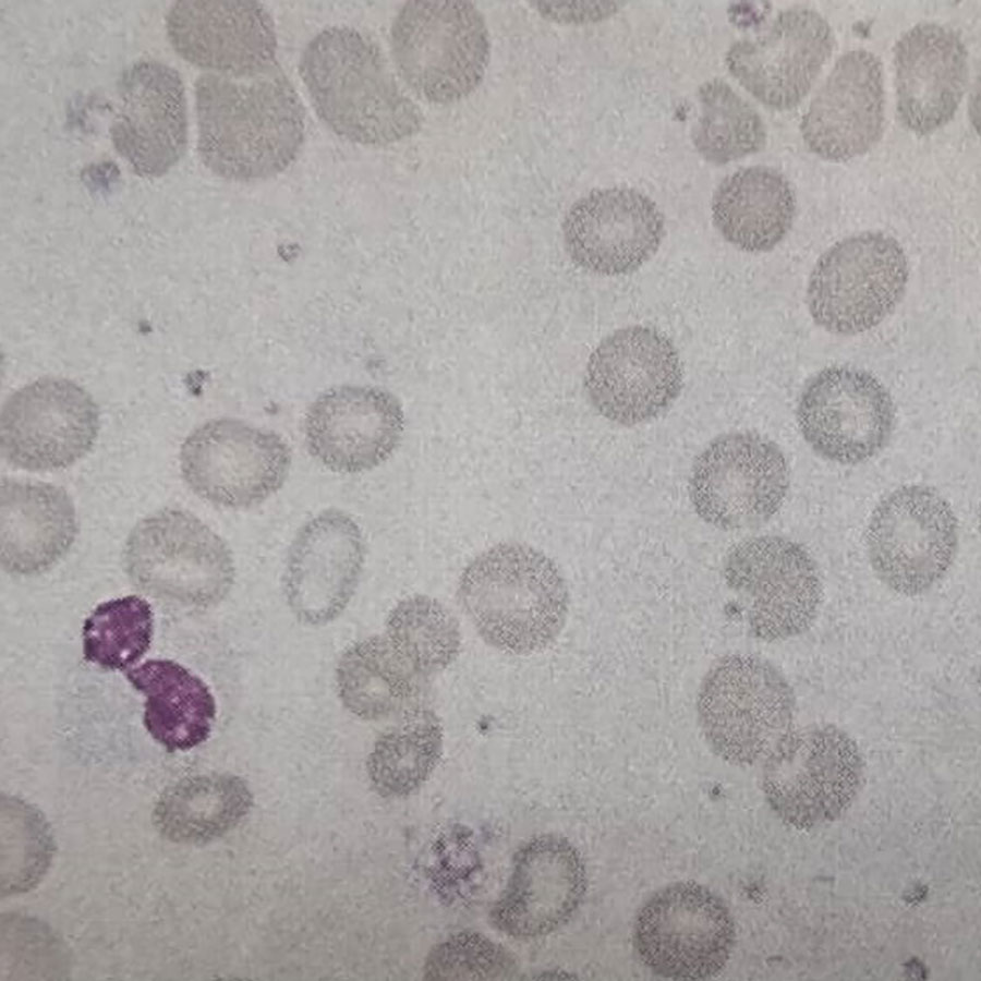 ظاهر گسترش خون محیطی بیمار