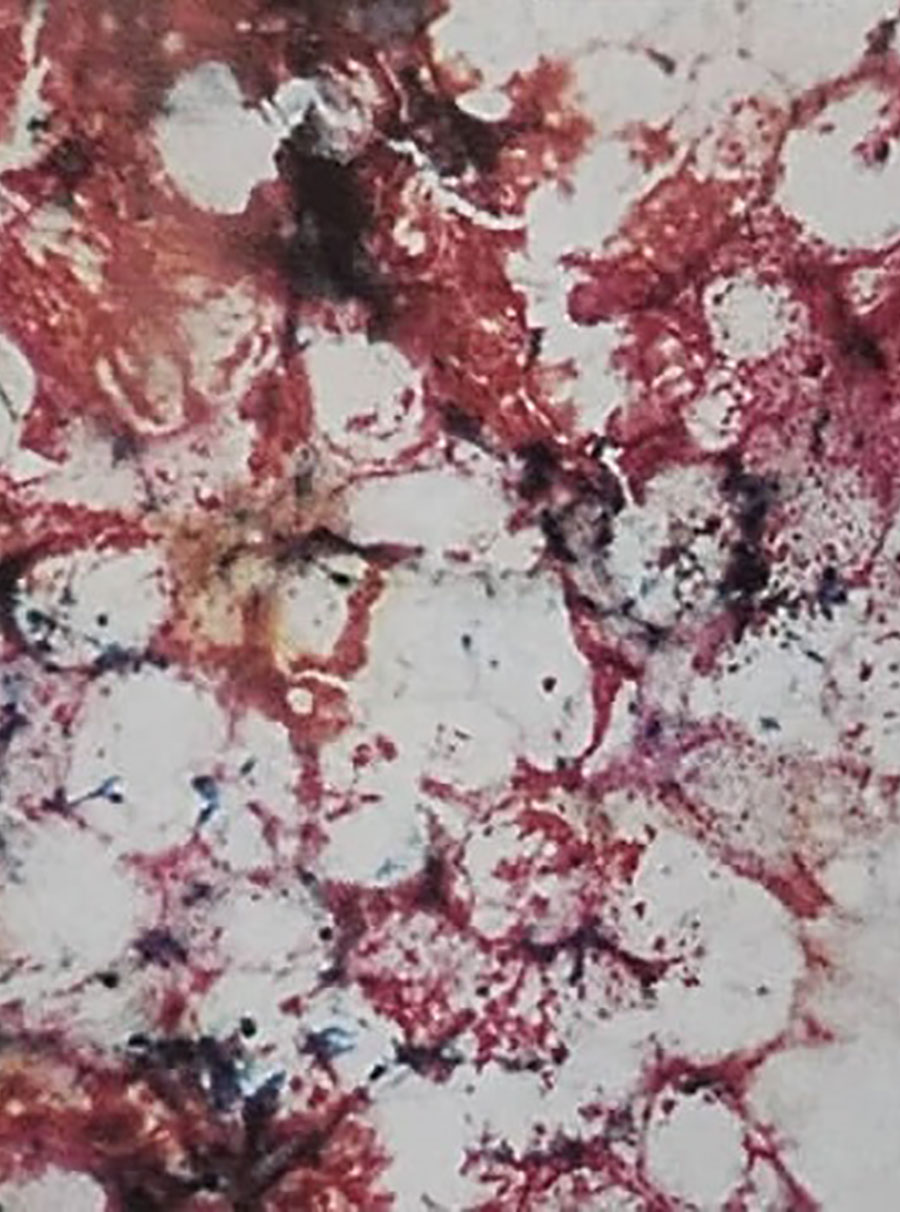 آسپیراسیون مغز استخوان با رنگ‌آمیزی پرلز (Perl’s stain) افزایش آهن