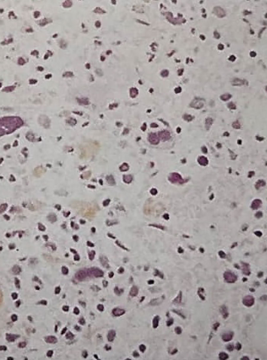 بیوپسی ترفین مغز استخوان - افزایش هموسیدرین