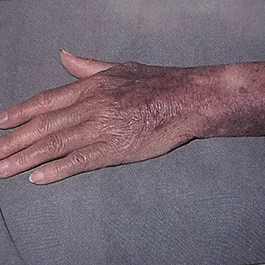 اکیموز گسترده (کبودی‌های وسیع پوستی)