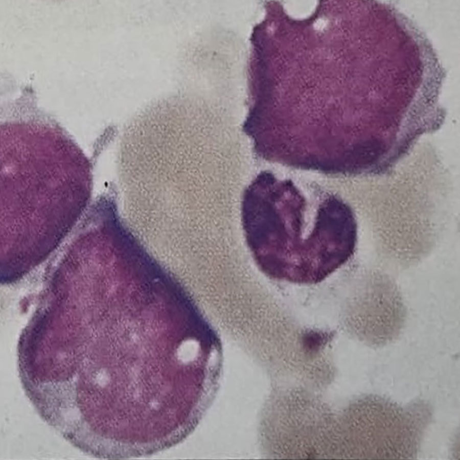 وجود بلاست‌ها در خون یا مغز استخوان