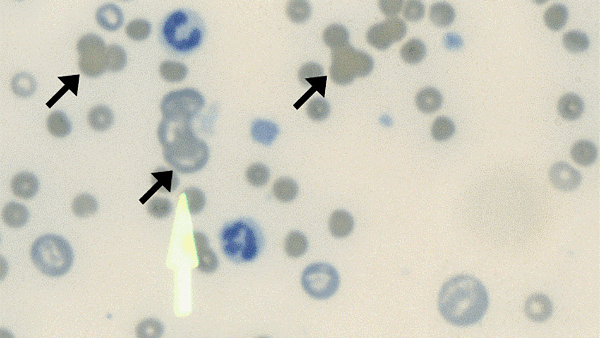 آگلوتیناسیون