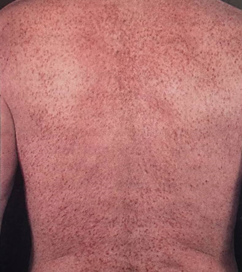 راش پوستی منتشر و بسیار خارش‌دار روی تنه