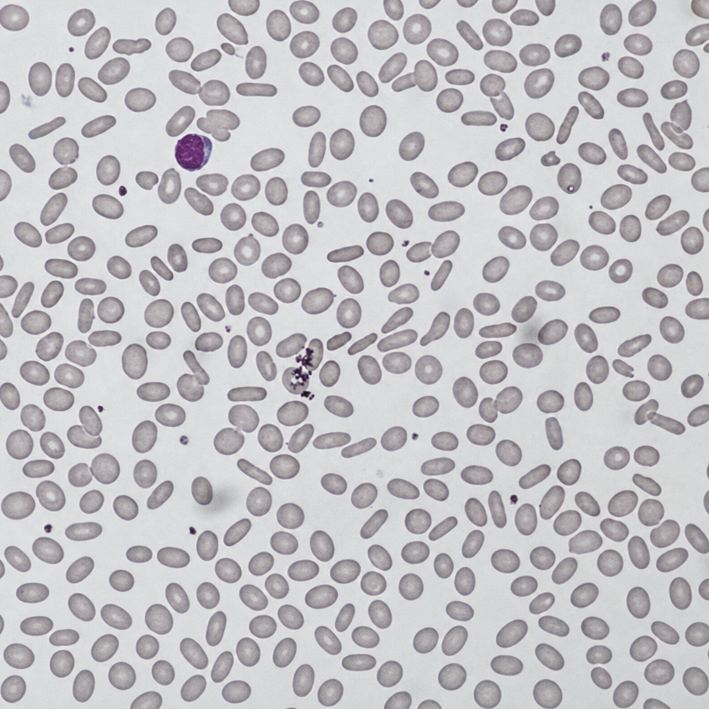 case-23 الیپتوسیتوز ارثی