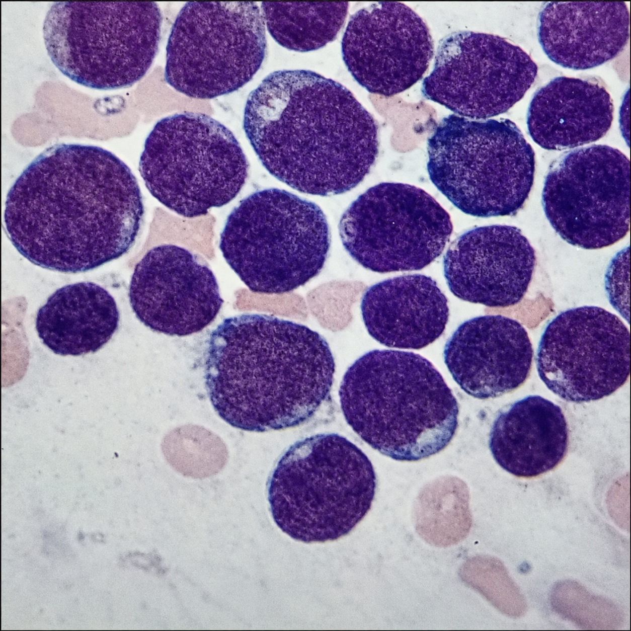 case-31 سلولهای بلاست