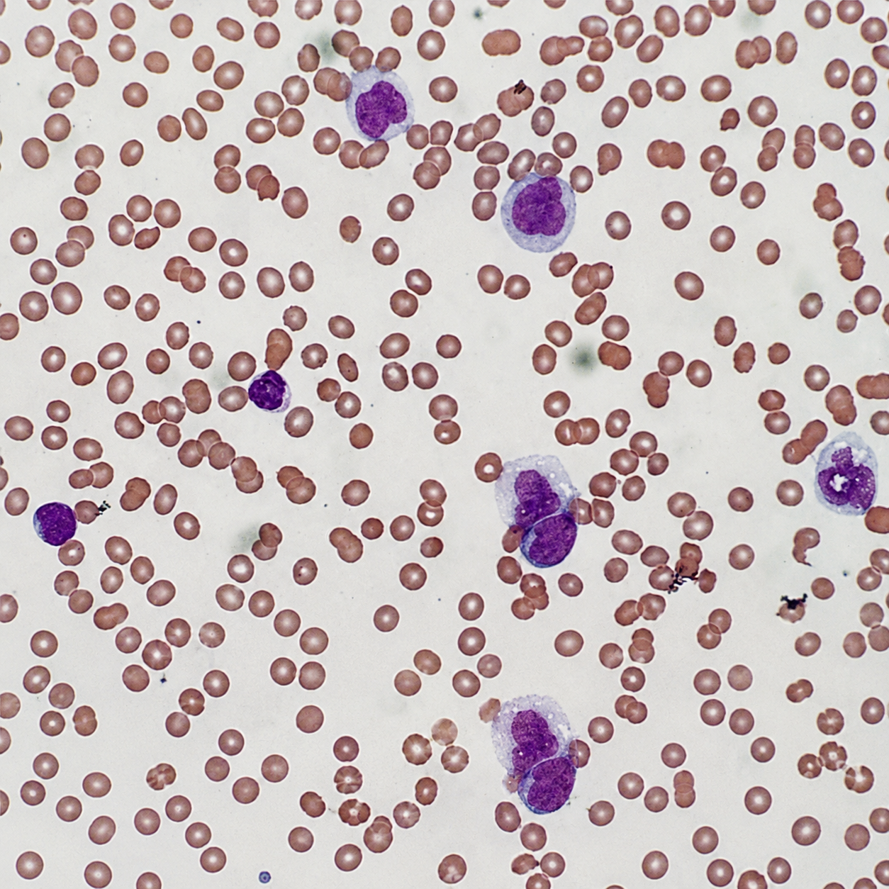 case-39 لوسمی حاد