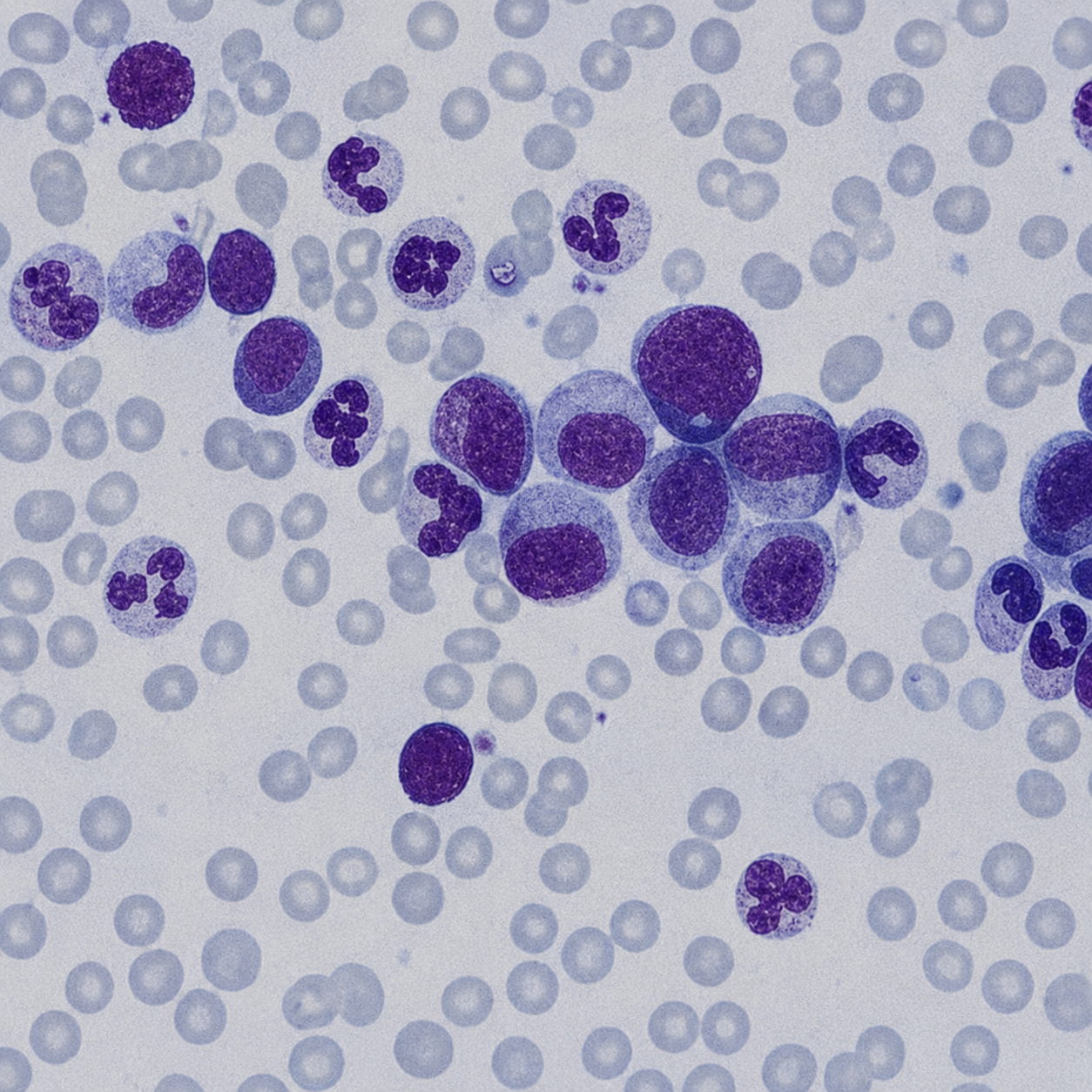 case-44 بزرگی متوسط طحال