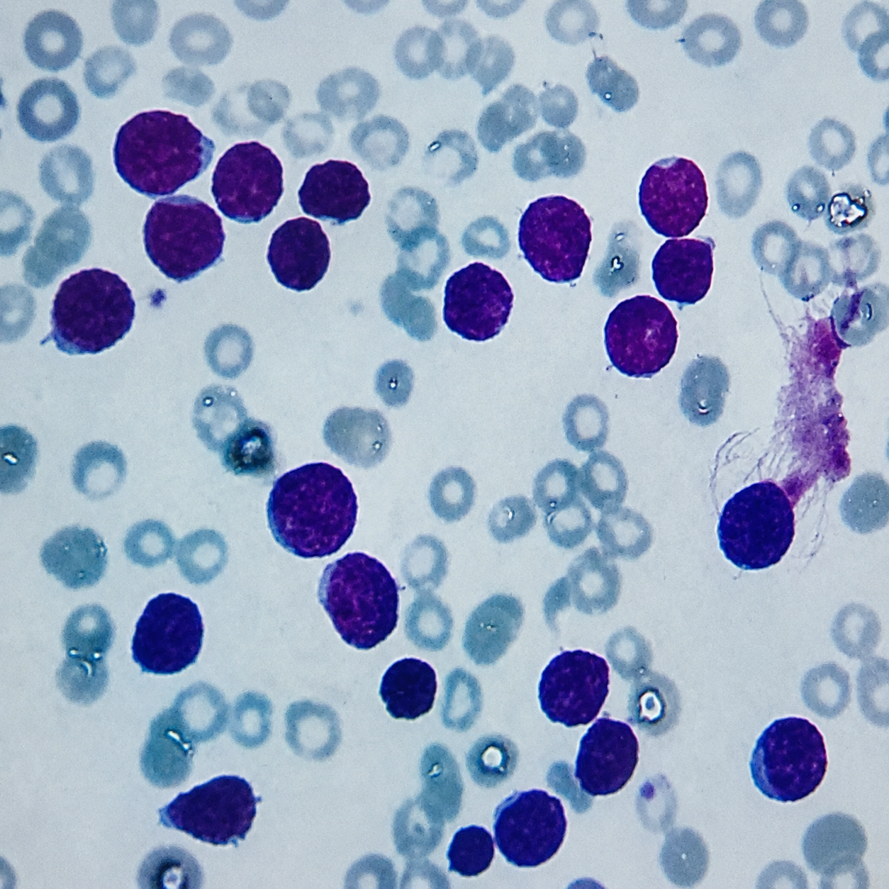 case-62 لوسمی لنفوبلاستیک حاد
