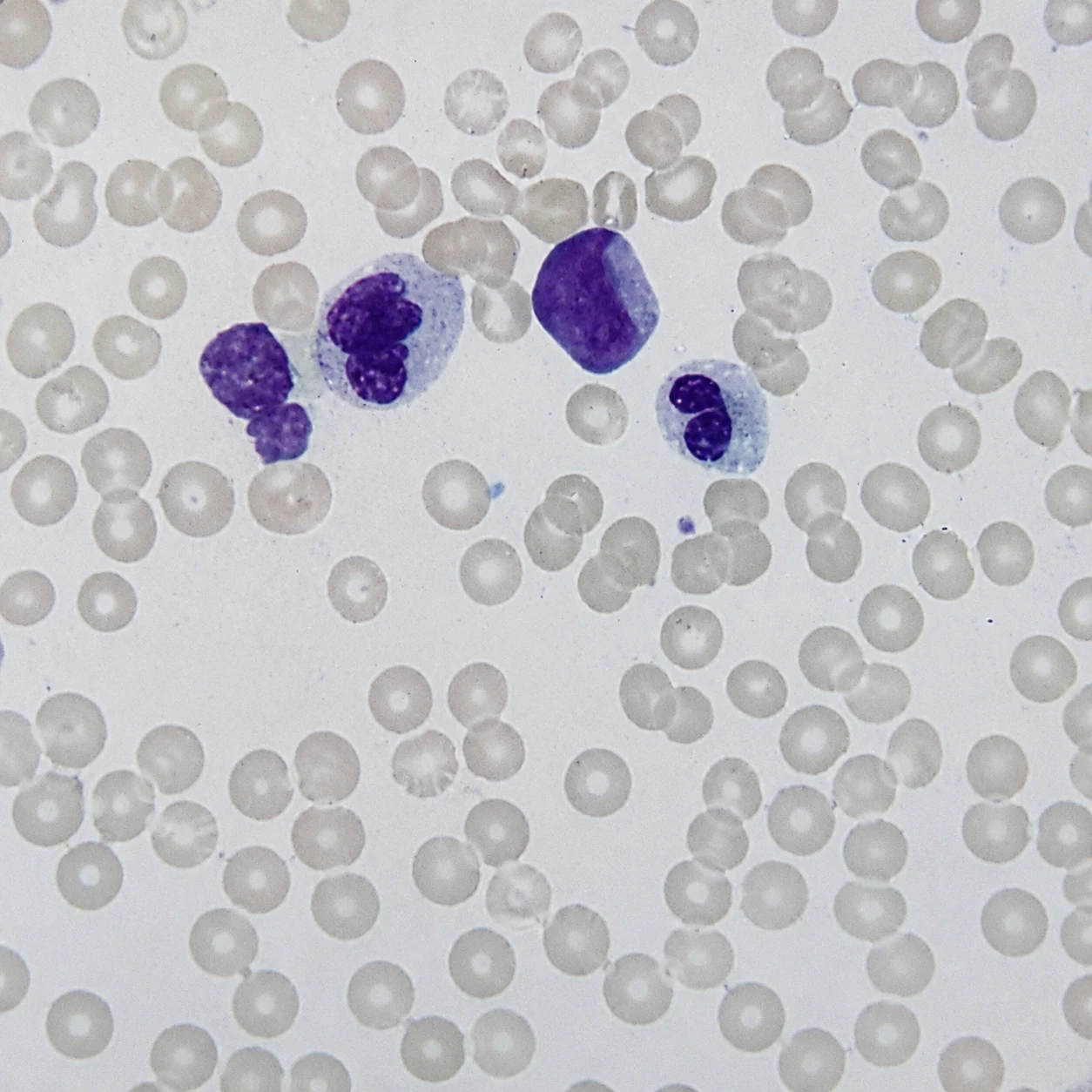 case-73 لوسمی میلوبلاستیک حاد