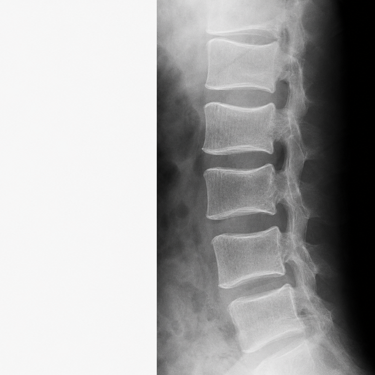 case-92 تفکیک واضح بین قشر و مدولا