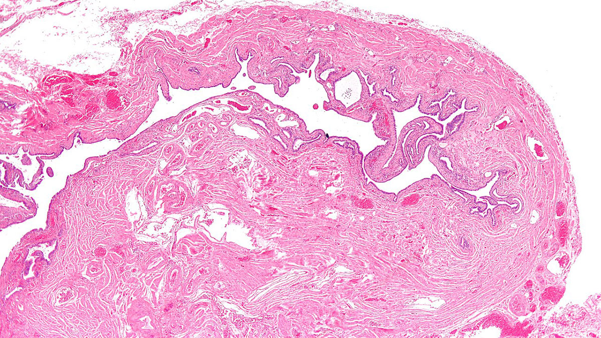 Salpingitis (3) التهاب و عفونت لولههای فالوپ