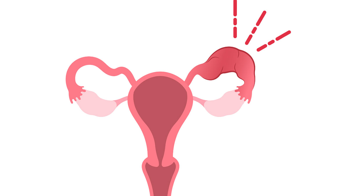 Salpingitis عوارض جانبی سالپنژیت