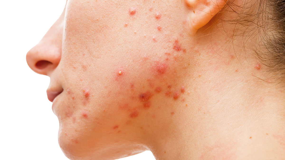 تظاهرات بالینی باکتری Cutibacterium acnes