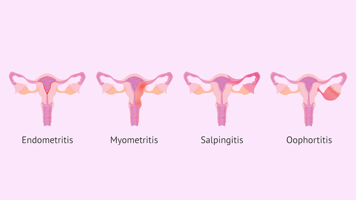 pelvic-inflammatory-diseases-types علائم سالپنژیت