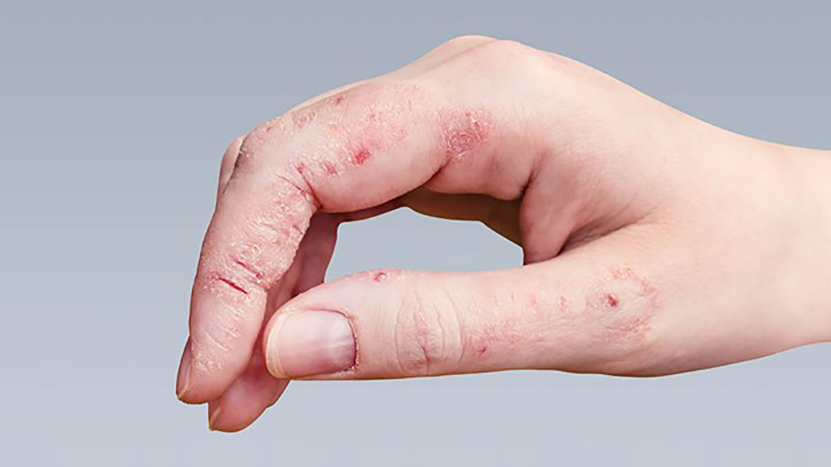 درمان قارچی پوست
